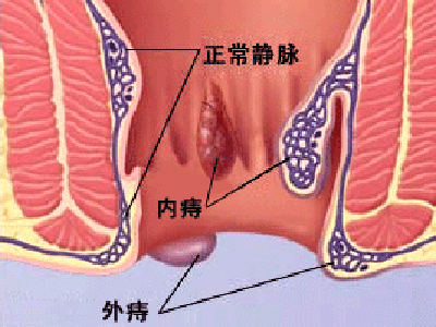 最新痔瘡治